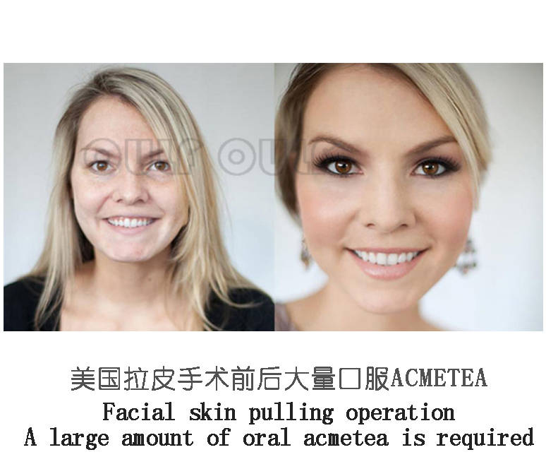 面部拉皮手术费用全面解析，多少钱才能实现美丽蜕变？