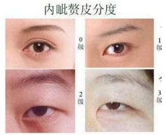 开眼角手术费用详解，价格因素与手术重要性