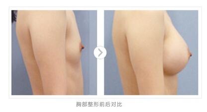 自体活细胞隆胸，探索现代美容的新领域