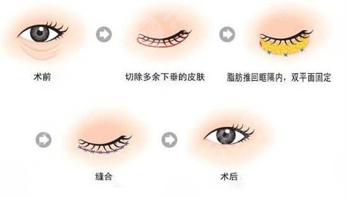 内切去眼袋，重塑眼部魅力的先进方法