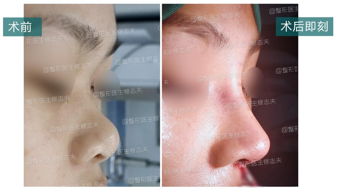 假体隆鼻手术，重塑完美鼻型的艺术与科学