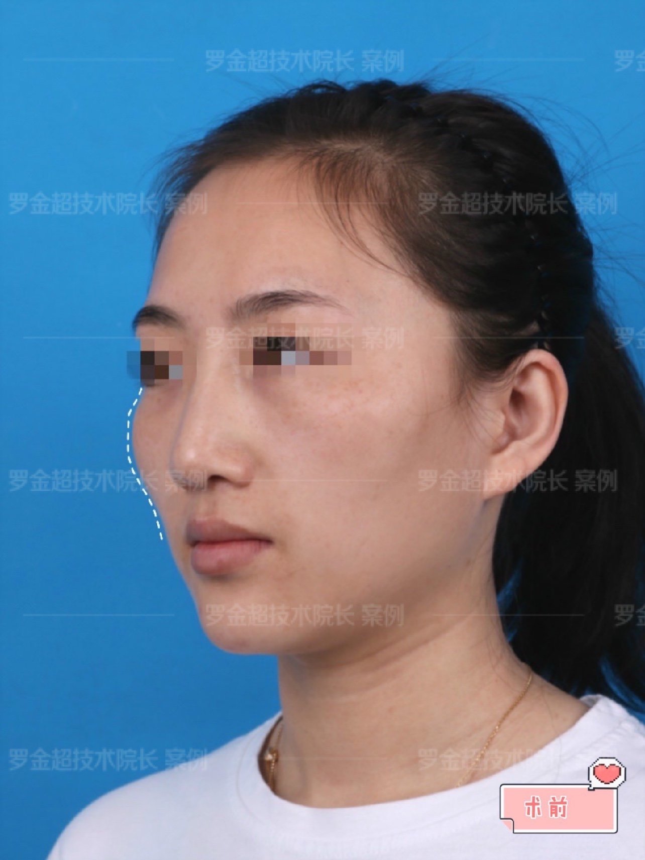 高颧骨整形的探索与实践