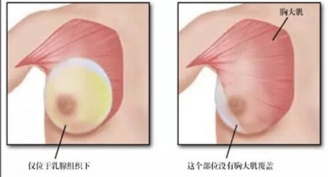 隆胸假体取出，过程、原因与后续护理
