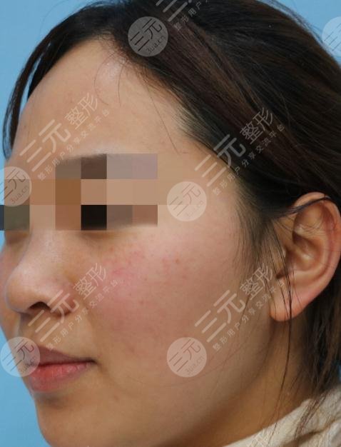激光去除红血丝的费用分析
