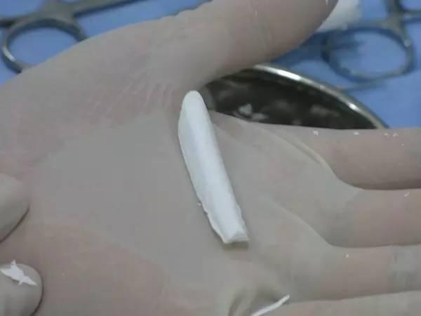 取隆鼻假体，重塑自信的必经之路
