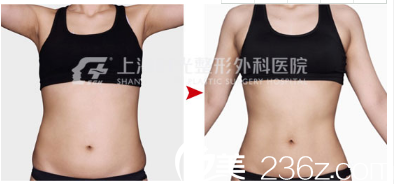 吸脂失败，经历与反思