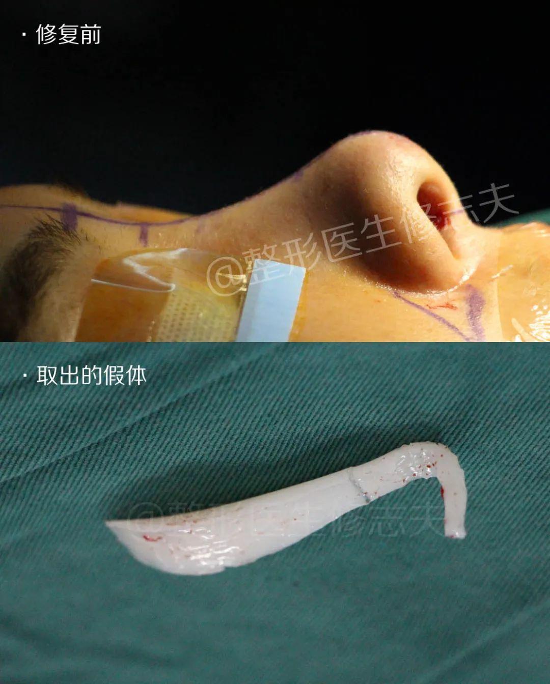 激光永久脱毛价格，全面解析脱毛成本与因素
