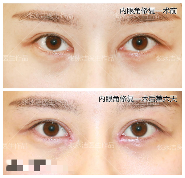 开眼角手术是否会留下疤痕，深度解析与应对策略