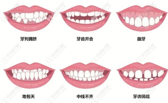 凸嘴手术，矫正与重塑面部轮廓的过程
