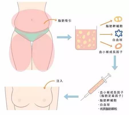隆胸手术费用全面解析，价格因素与考虑