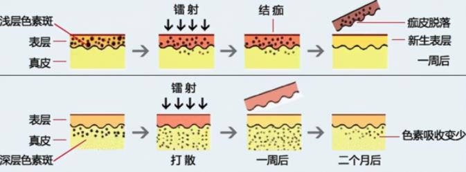 彩光祛斑会反弹吗？深度解析彩光祛斑技术与反弹问题
