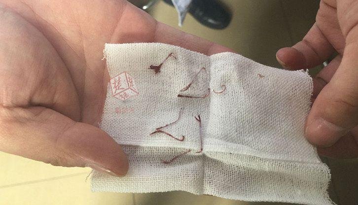 吸脂手术，现代美容外科的塑形新选择