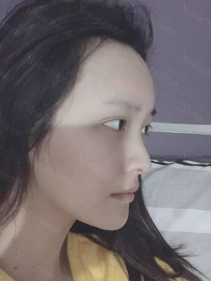专业臀部吸脂减肥术，重塑美丽曲线