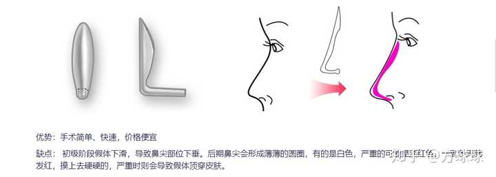 隆鼻手术价格，全面解析与深度探讨