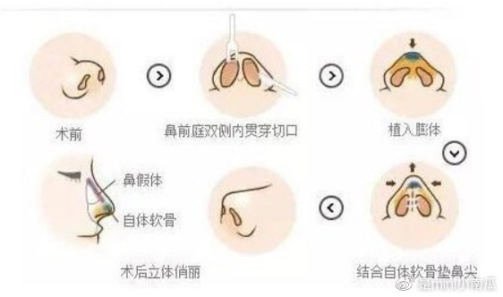 假体隆鼻的危害，深入了解与预防措施