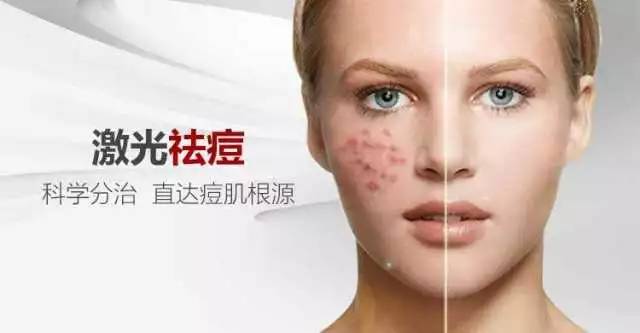 激光祛痘恢复时间，了解并优化你的肌肤再生过程