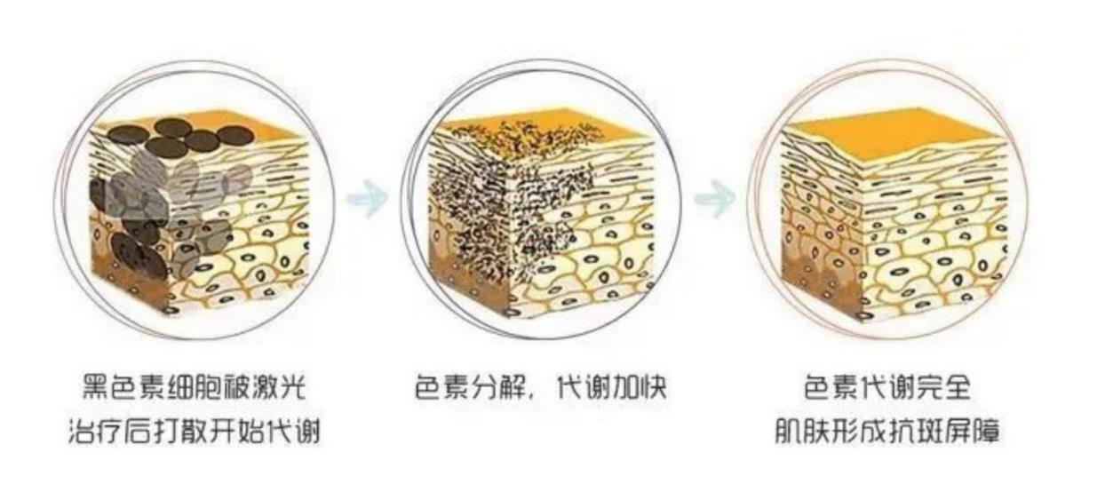 激光祛斑，价格分析与费用概述