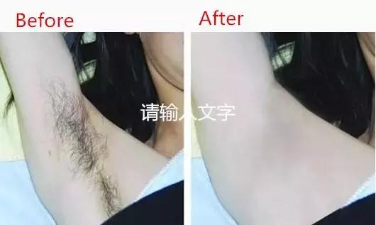 腋窝脱毛，走进新时代的美体新选择