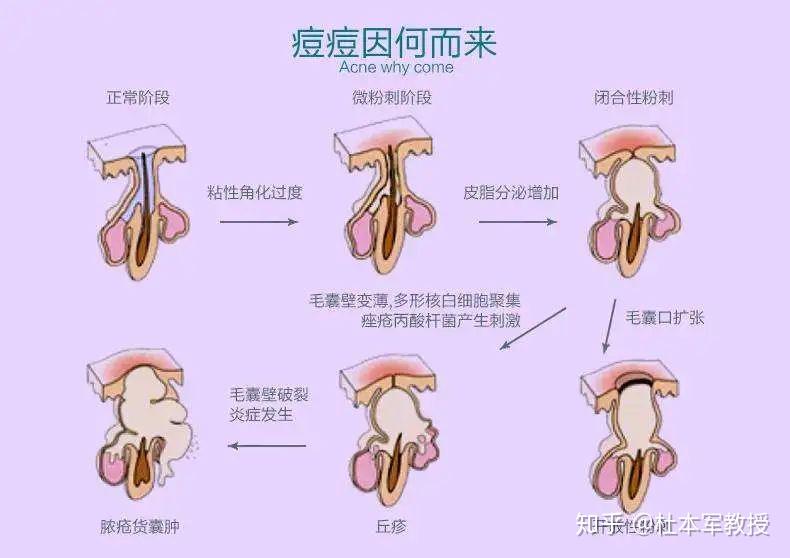 激光祛痘后遗症，了解、预防与应对