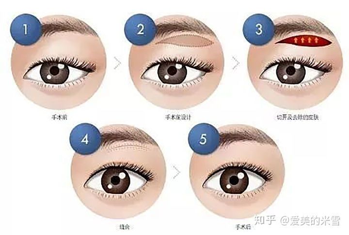 双眼皮手术费用全面解析，多少钱做双眼皮？