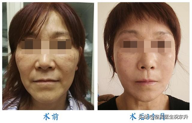 法令纹手术，重塑面部轮廓的新选择