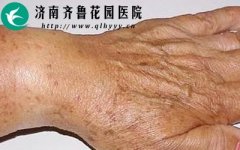 激光治疗老年斑价格，全面解析与指导