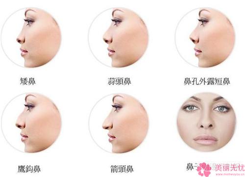 假体隆鼻整容的价格因素与考量