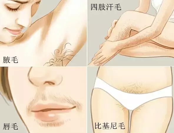 冰点脱毛，次数与效果解析