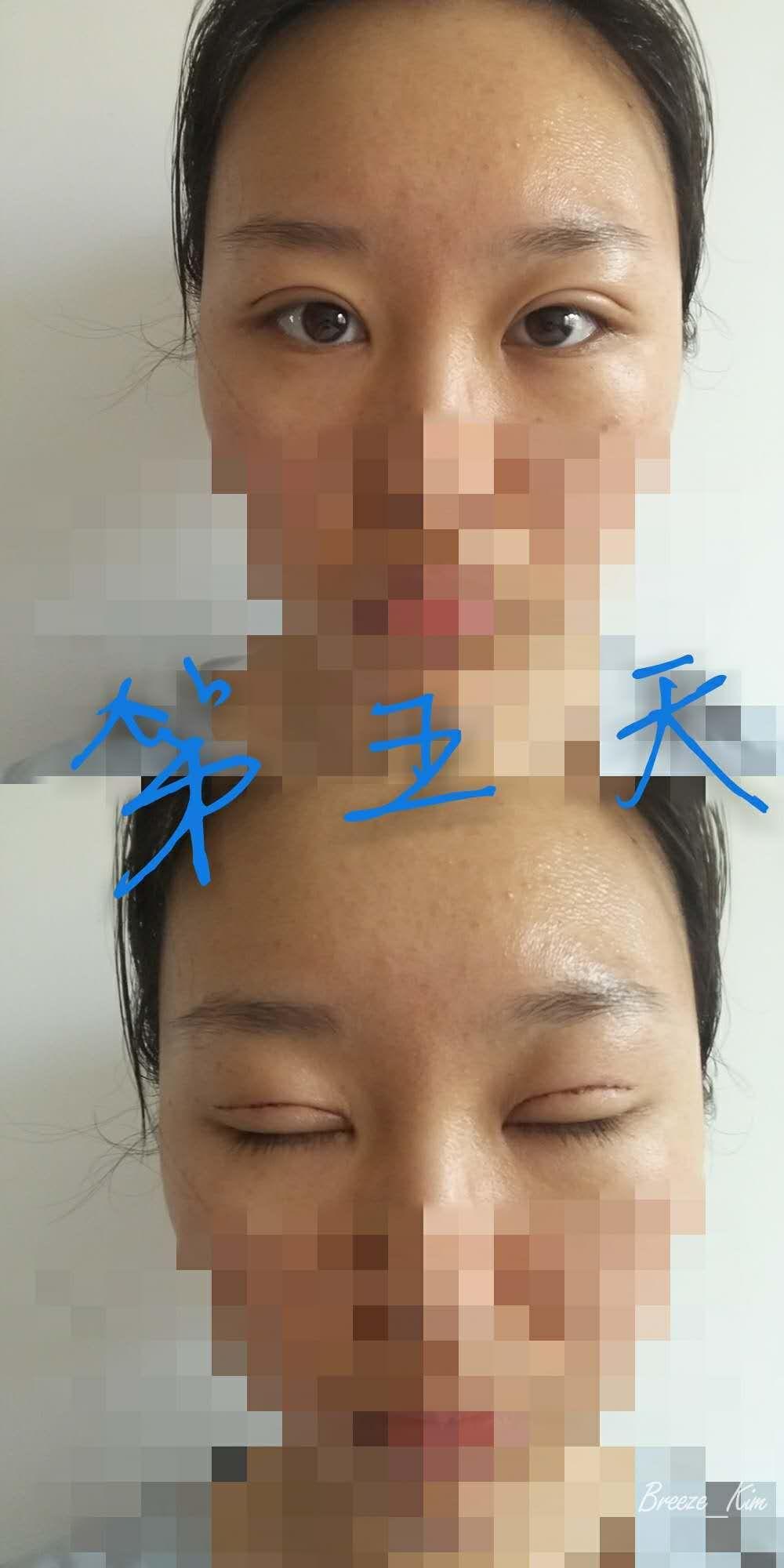 双眼皮全切手术，过程与恢复图片详解