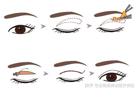 双眼皮埋线的魅力与探索
