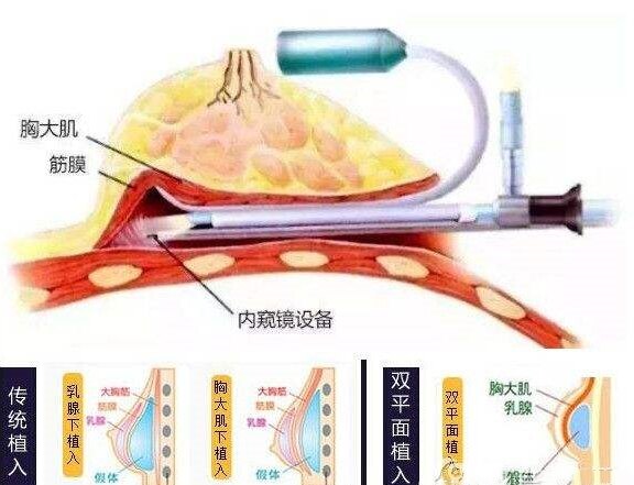 内窥镜技术下的假体丰胸，革新与安全的完美结合