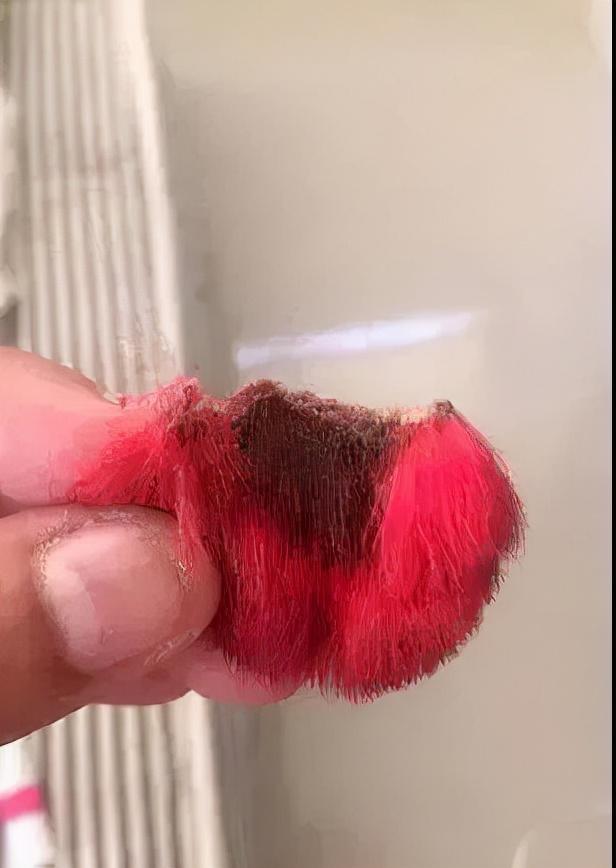 玻尿酸丰耳垂，重塑完美耳部轮廓的新选择
