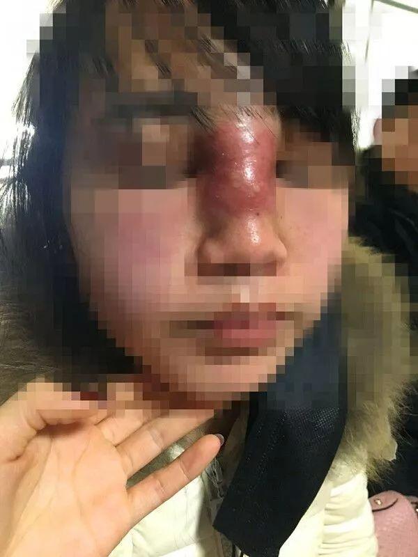 隆鼻手术价钱，深入了解与全面解析