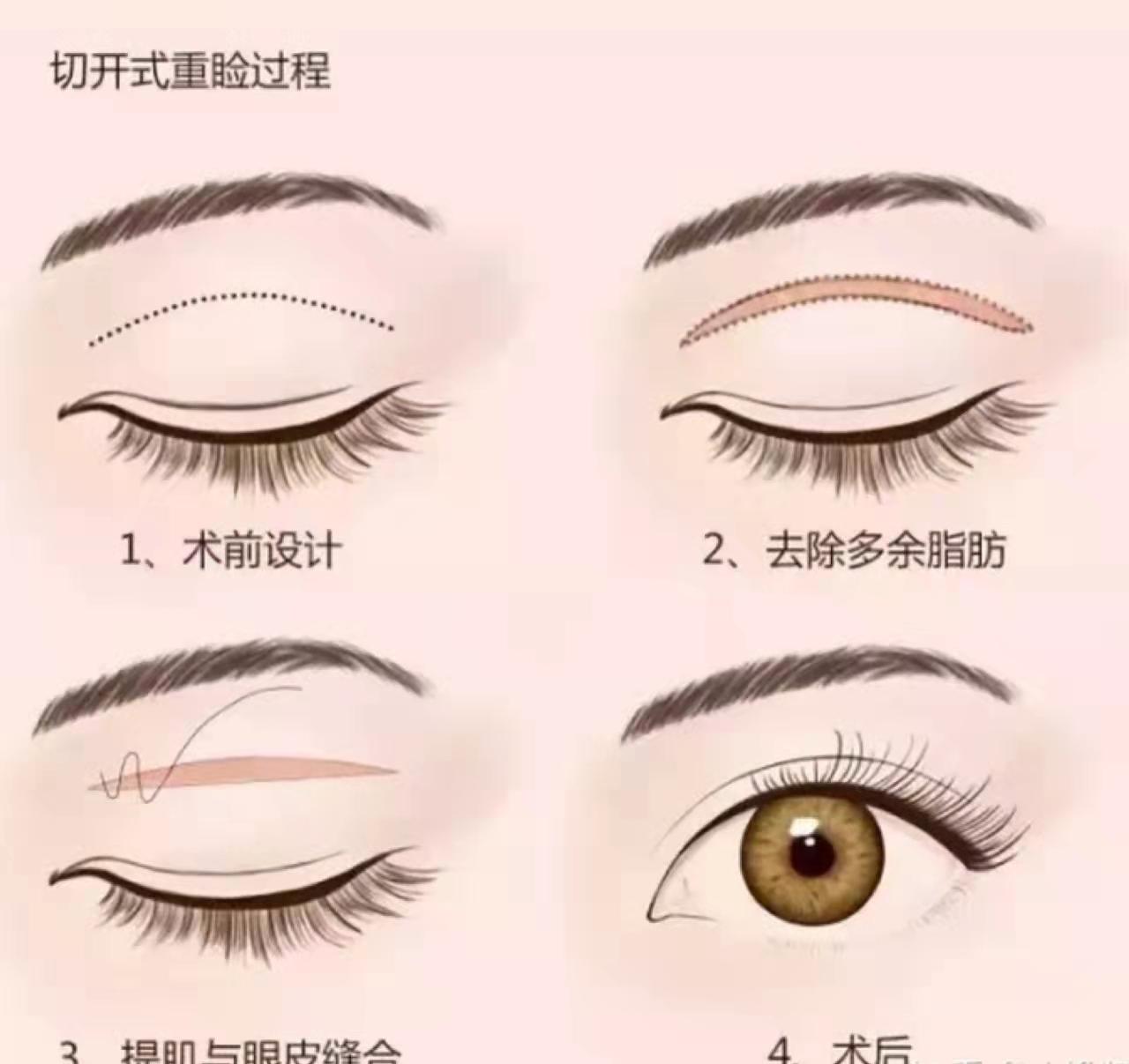 双眼皮塑造美丽，割双眼皮价钱详解