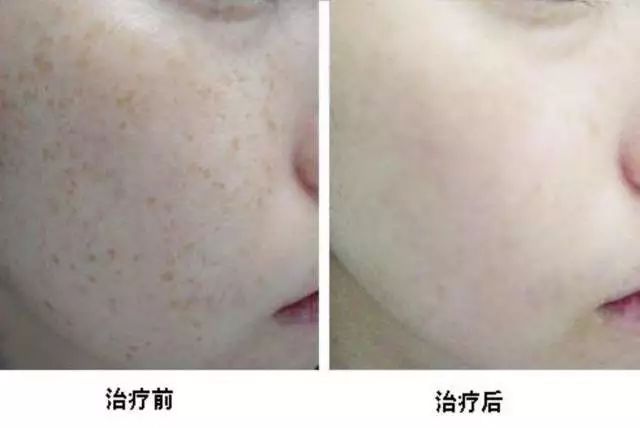 激光祛斑的费用详解，了解、预算与选择