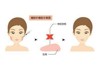 瘦脸针价格费用详解，了解、比较与选择