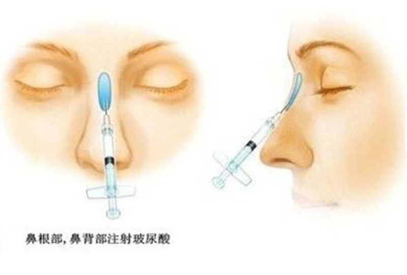 隆鼻安全，打造美丽鼻子的正确路径