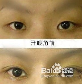 开眼角是什么，深入了解眼部整形手术的一种