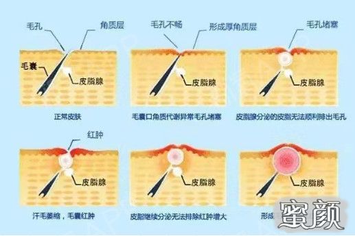激光收缩毛孔，重塑肌肤新境界