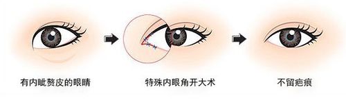 开眼角手术方法，重塑眼部魅力的秘密武器