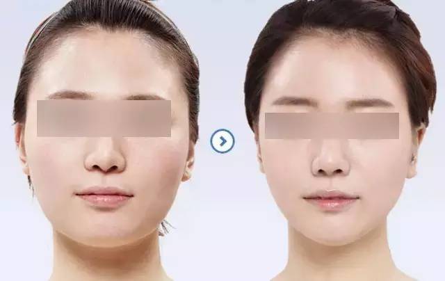 探索瘦脸针，实现瘦脸的新途径
