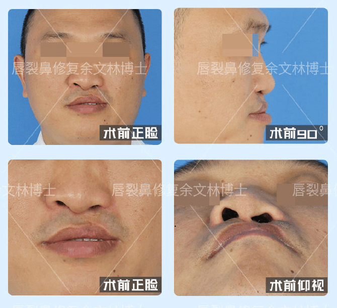 鼻翼缩小手术恢复，重塑美丽与自信的旅程