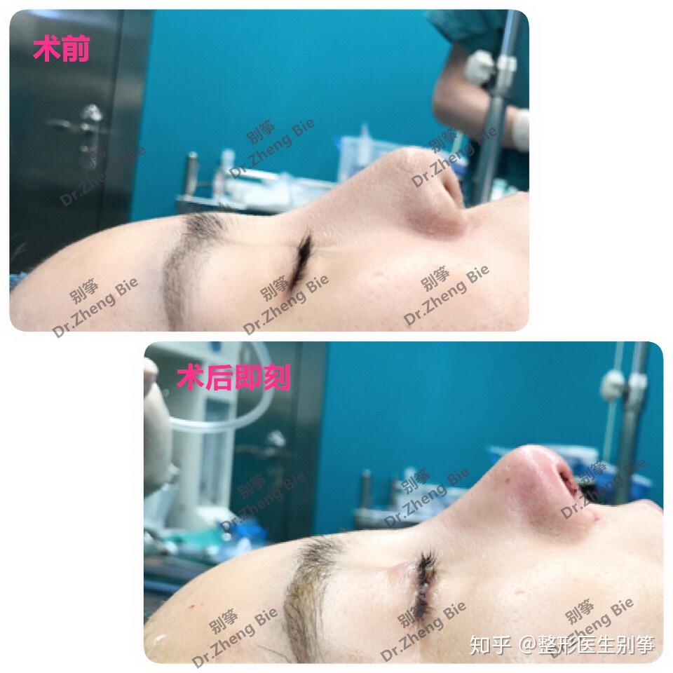 鼻假体取出术，过程、注意事项与后续护理