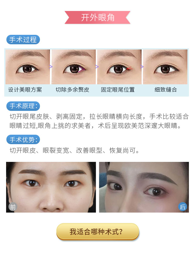 开眼角手术费用详解，价格因素与考量