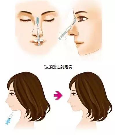 注射丰下巴，重塑美丽轮廓的新选择