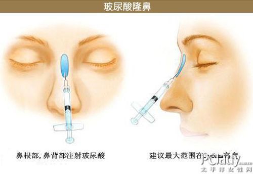 关于隆鼻手术的费用，多少钱才能实现美丽梦想？
