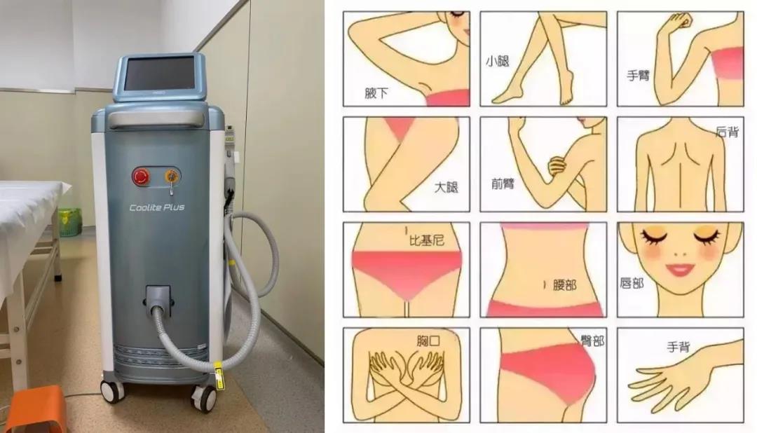 激光去毛，现代脱毛技术的革新