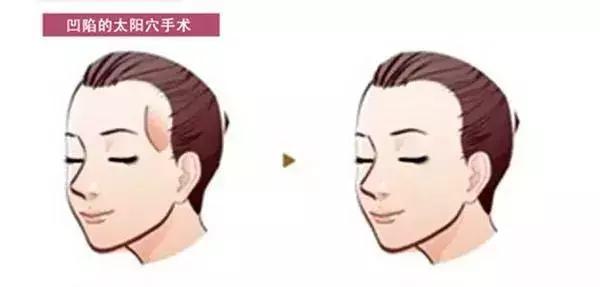 自体脂肪填充太阳穴，重塑面部轮廓的新选择