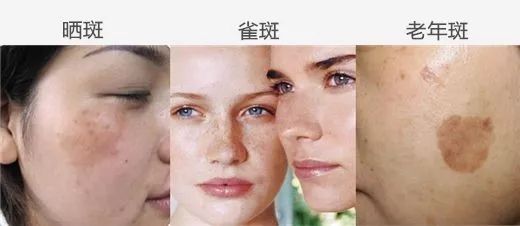 祛斑价格大解析，了解祛斑的成本与费用因素
