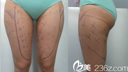 瘦大腿吸脂价格，全面解析与指导